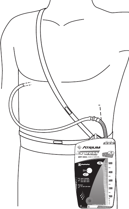 Atrium Express Mini 500 - Dry Seal Chest Drain Patient Manual and Video ...