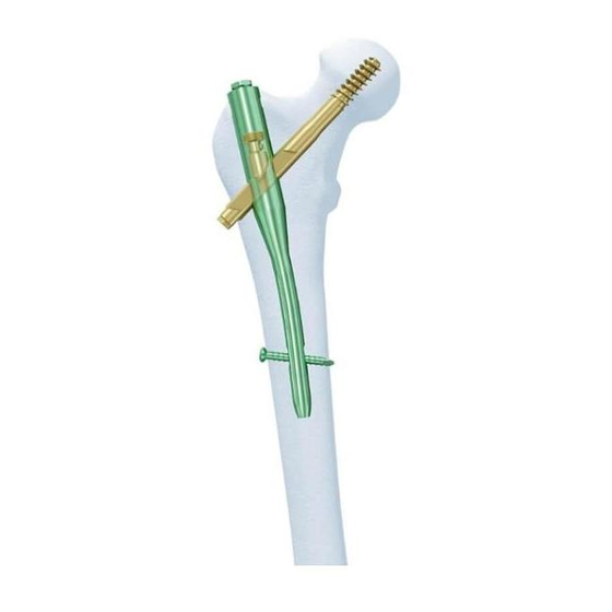 Synthes Titanium Trochanteric Fixation
Nail System Technique Manual