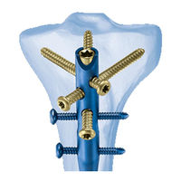 Synthes Expert Tibial Nail Technique Manual