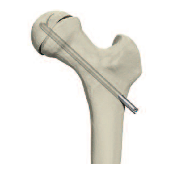 Stryker Hansson Pin System Manual