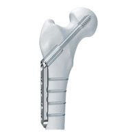 Synthes DCS Surgical Technique